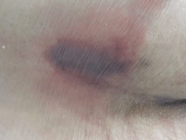 褥瘡発生当初　DTI疑い、サイズ3.5cm×2.5cm