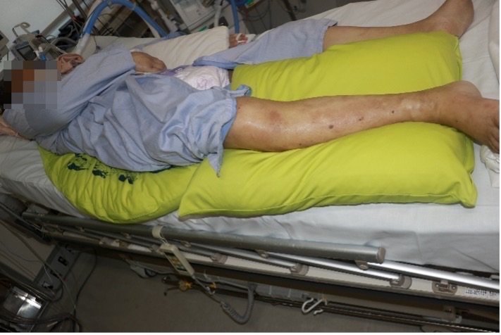 ICU：リスク軽減のために、分割して複数組み合わせて使用➁